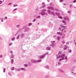 Drüse Prostatakarzinom
