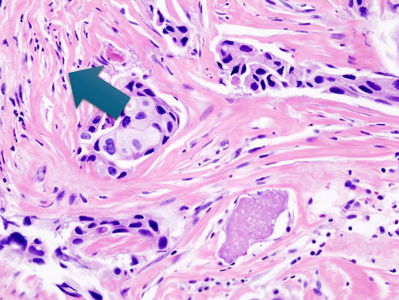 Tumorstroma